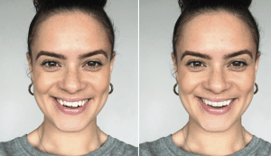 Invisalign Smileview